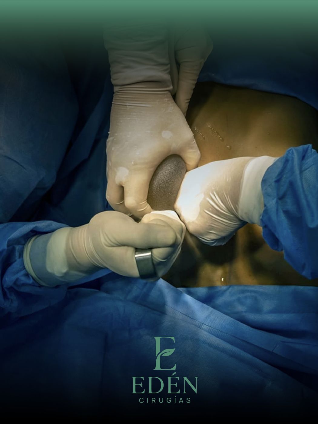 Fotografía clínica de resultado de implantes mamarios (cirugía plástica) realizada en Edén Cirugías, Guayaquil.